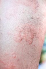 urticaria on skin. rashes, of which urticaria and toxic erythema are the most common.