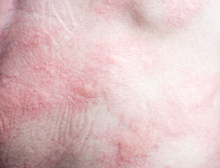 Fototapeta premium urticaria on skin. rashes, of which urticaria and toxic erythema are the most common.
