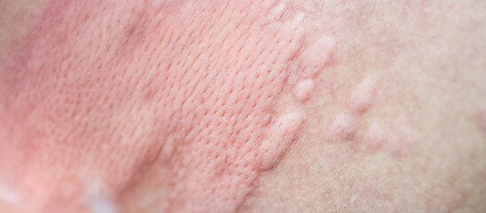 Fototapeta premium urticaria on skin. rashes, of which urticaria and toxic erythema are the most common.