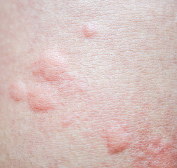 Fototapeta premium urticaria on skin. rashes, of which urticaria and toxic erythema are the most common.