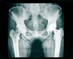 X-ray of the pelvis Endoprosthesis