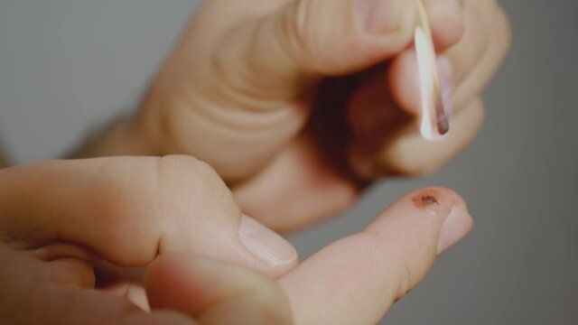 Cauterization of wart. The man cauterizes the wound on his finger with a match.