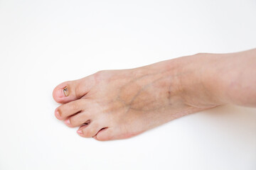 Fungal infection of the toenails. The result of wearing tight shoes. A protruding bone and varicose veins. Close-up