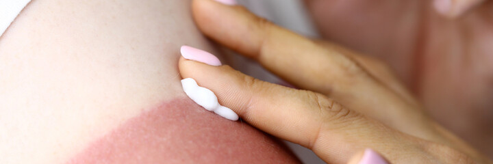 Obraz na płótnie Canvas Female hand applies sunburn cream to male hand. Consequences of sunburn concept