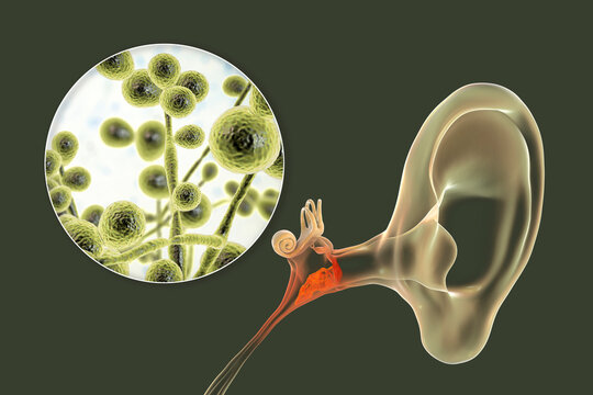 Chronic suppurative otitis media