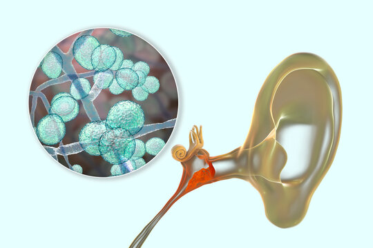 Chronic suppurative otitis media