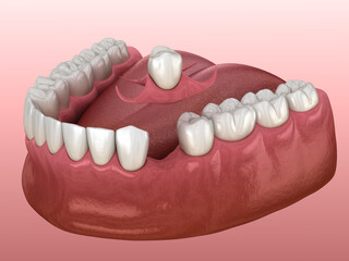 Partial removable immediate-denture type Butterfly. Replacement of one missing tooth 3D illustration - obrazy, fototapety, plakaty