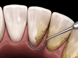 Closed curettage: Scaling and root planing (conventional periodontal therapy). Medically accurate...