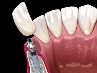 Standard abutment, dental implant and ceramic crown. Medically accurate tooth 3D illustration. - obrazy, fototapety, plakaty