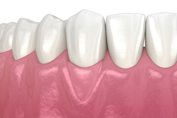 Gum Recession: Soft tissue graft surgery. 3D illustration of Dental  treatment