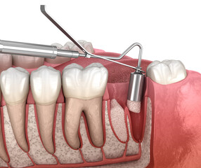 Augmentation Surgery - recovery with artificial bone after tooth extraction. 3D illustration