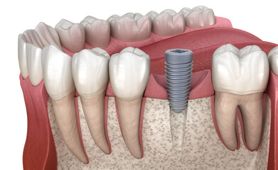 Implant abutment installation procedure. Medically accurate 3D illustration of human teeth and dentures concept