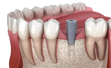 Implant abutment installation procedure. Medically accurate 3D illustration of human teeth and...