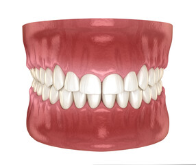 Frontal crown lengthening, Esthetic surgery. Medically accurate dental 3D illustration