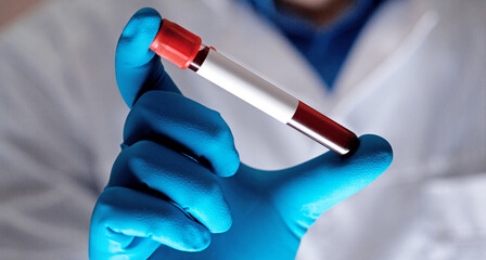 Coronavirus 2019-nCoV Blood Sample.