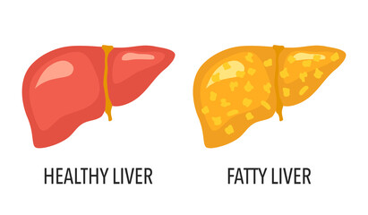 Comparison of healthy liver and fatty liver disease. Human healthcare concept vector illustration on white background.