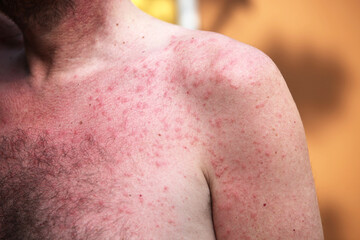 Rash or sun allergy