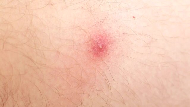 Red pimple boil on the skin, background, macro, dermatology