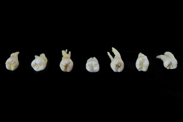 Torn diseased human teeth stacked in a row isolated on black background. Close-up photo of spoiled molars and premolars.