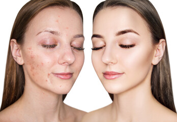 Face of beautiful woman before and after acne treatment. Beautician concept.