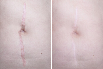 Hypertrophic keloid scar on woman stomach before and after laser treatment, removal, heal and...