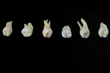 Torn diseased human teeth stacked in a row isolated on black background. Close-up photo of spoiled...