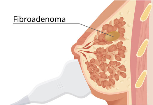 Ultrasound of the breast . Fibroadenoma imaging technique