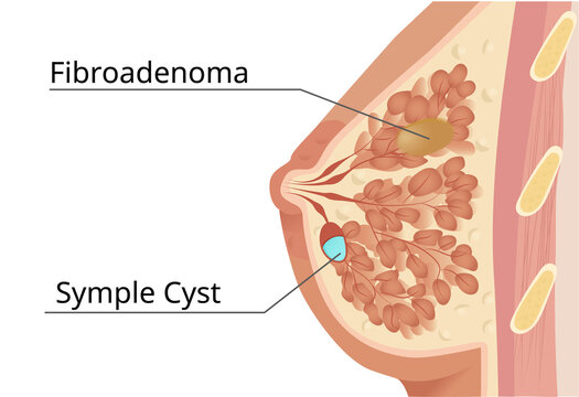 Fibro-cystic mammry gland lesions. Illustration of the fibroadenoma and cyst within the breast tissue