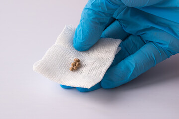 The doctor's hand in a blue glove holds the cut out kami from the gallbladder.