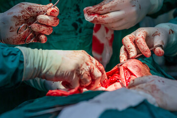 Doctors operating neck tumor in hospital