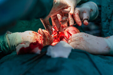 Doctors operating neck tumor in hospital