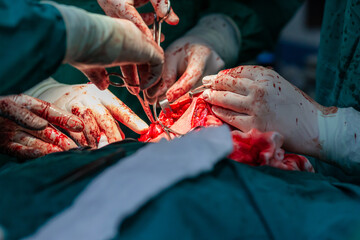 Doctors operating neck tumor in hospital