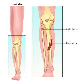 Medical illustration comparing a healthy leg to one with a fractured tibia and fibula.