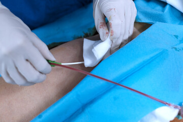 Scrub nurse pull introducer sheath from femoral artery and press at puncture site of patient’s groin
