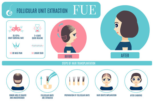 Female hair loss FUE medical treatment vector infographic. Stages and benefits of follicular unit extraction procedure for women. Alopecia design  for transplantation clinics and diagnostic centers.