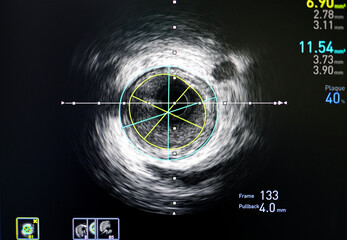 Intravascular ultrasound imaging (IVUS) for assessment inside coronary artery, cardiac catheterization laboratory