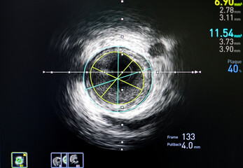 Intravascular ultrasound imaging (IVUS) for assessment inside coronary artery, cardiac...