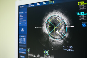 Intravascular ultrasound imaging (IVUS) for assessment inside coronary artery, cardiac catheterization laboratory