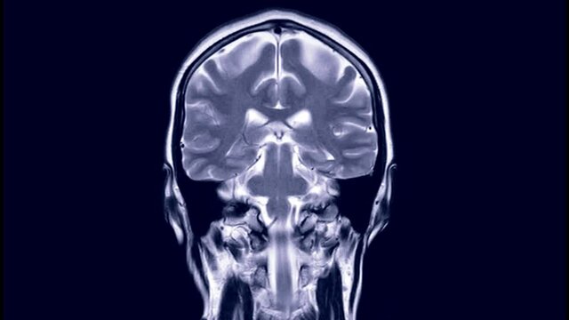 MRI brain or magnetic resonance imaging in Coronal T2W view.  