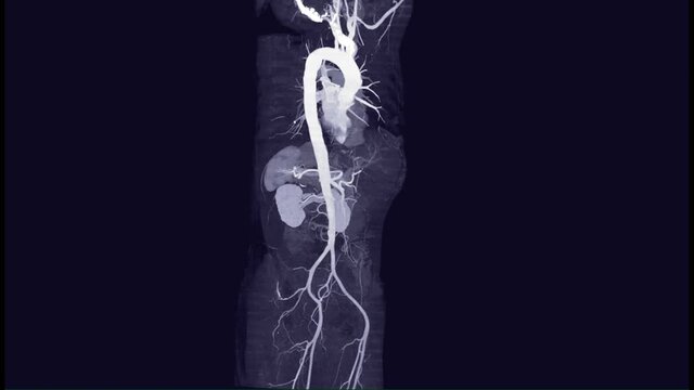 CTA Whole aorta 3D MIP view turn around on the screen for diagnosis Aortic dissection or aneurysm.