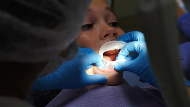 Applying mouth retractor to young male kid patient. Dental assistant places mouth safety guard or retractor on young boy preparing him for teeth cure procedure. 4 k video