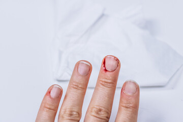 Bleeding, badly bitten nail cuticle 