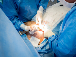 Surgery to remove the breast and replace it with an implant.