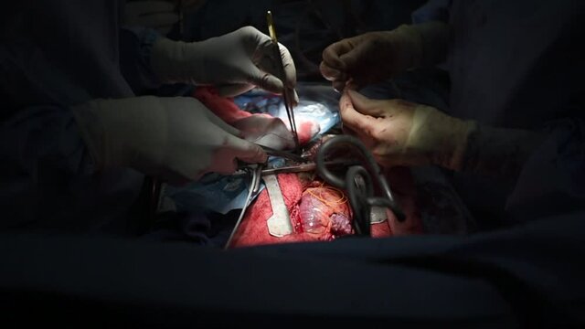 Graphic medical scene: Open heart surgery with exposed beating heart