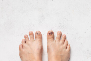 big toes with Subungual hematoma on white background. Effects wearing uncomfortable footwear. Take...