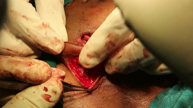 Face Joint dental operation temporomandibular joint dislocation