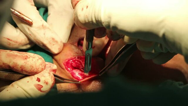 Face Joint dental operation temporomandibular joint dislocation