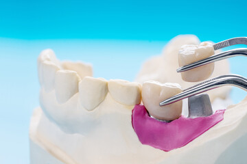 Closeup / Implant Prosthodontics or Prosthetic / Tooth crown and bridge implant dentistry equipment and model express fix restoration.
