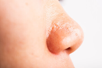 Closeup Asian young woman large pores have freckles cheek oily, acne pimple on nose, studio shot isolated on white background, Healthcare beauty skin face problem concept