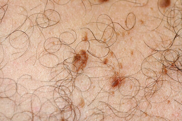 Brown spot on the skin. Pigmented spots and moles. Mole and skin hair.